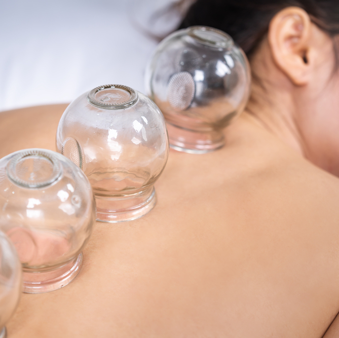 woman receiving cupping treatment on back